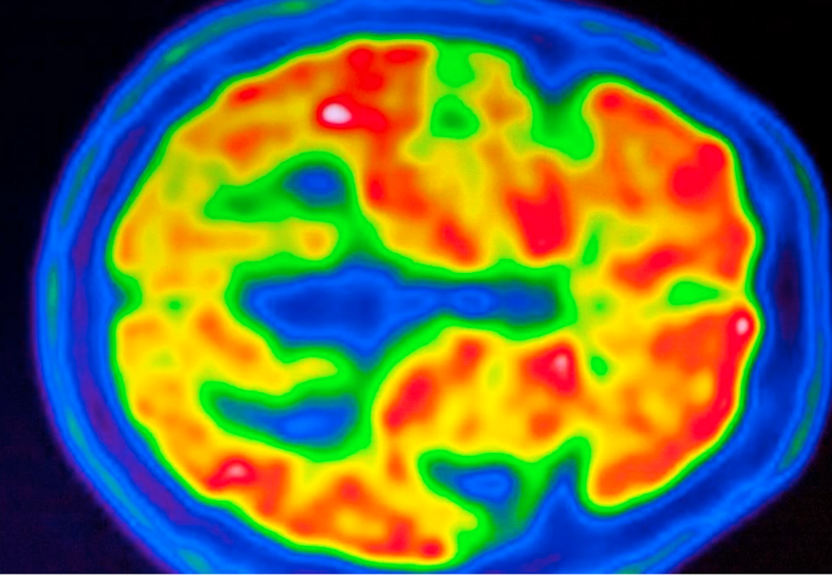 Resonancia cerebral